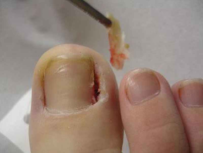 How do I stop my toenails from getting thick
