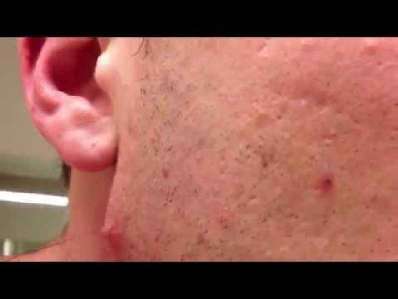 How do men remove facial hair completely
