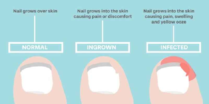 How do Podiatrists treat ingrown toenails