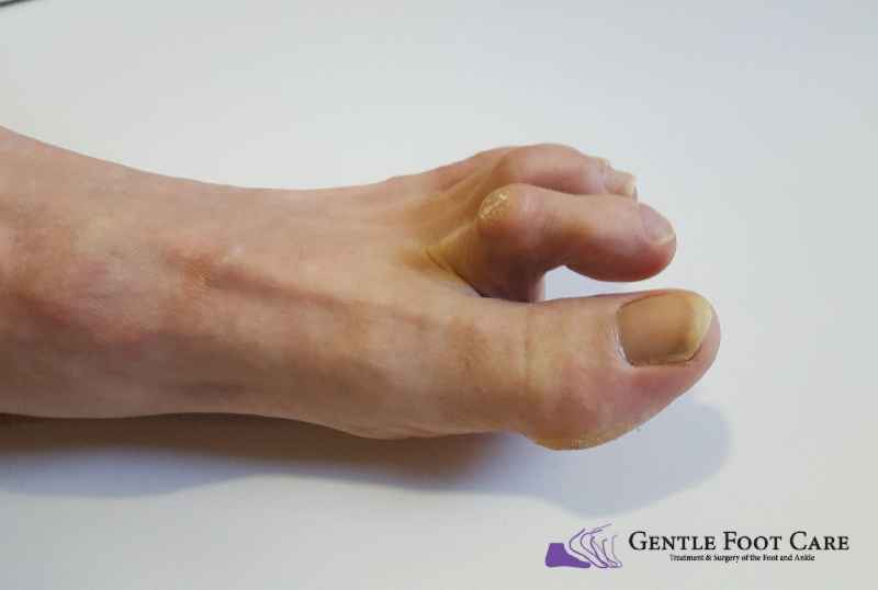 How do you bandage a big toe
