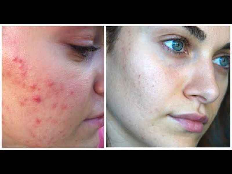 How do you cover acne scars with foundation