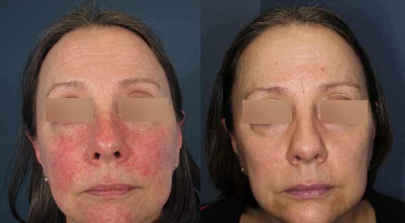 How do you cover the redness after laser