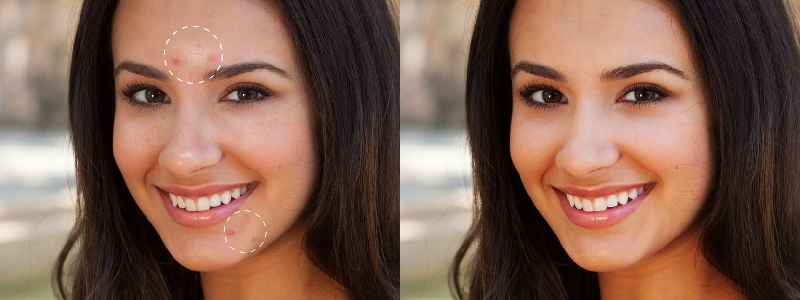 How do you cover up acne scars with Indian skin