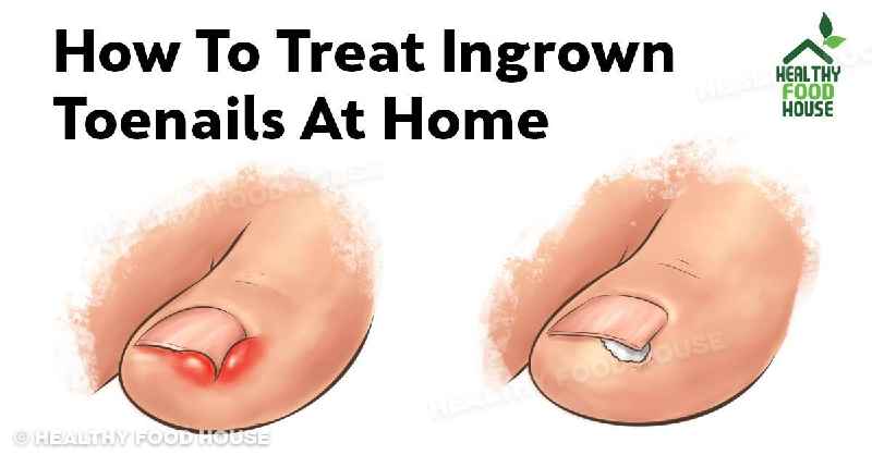How do you cut toenails with toenail fungus