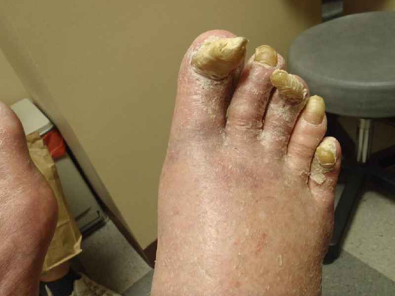 How do you do a pedicure with thick toenails