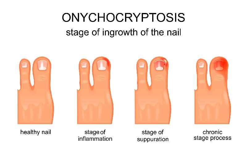 How do you drain pus from an ingrown toenail