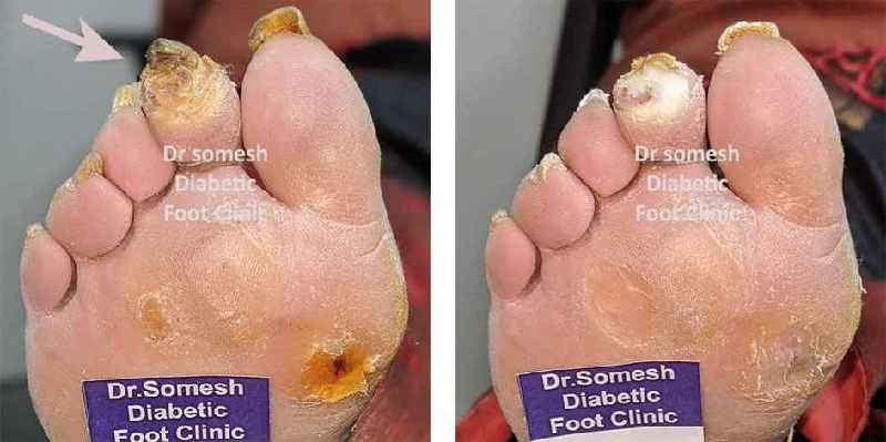 How do you dress a toe wound