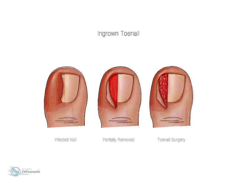 How do you dress your big toe after removing a nail