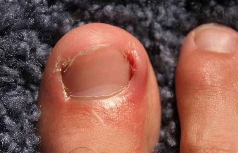 How do you fix an infected ingrown toenail