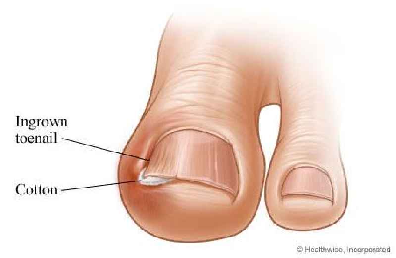 How do you get an ingrown toenail out of your big toe