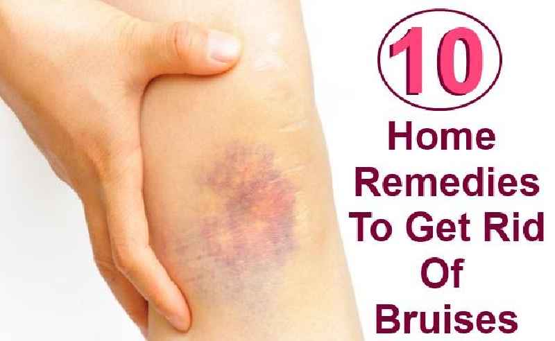 How do you get rid of a purple bruise fast