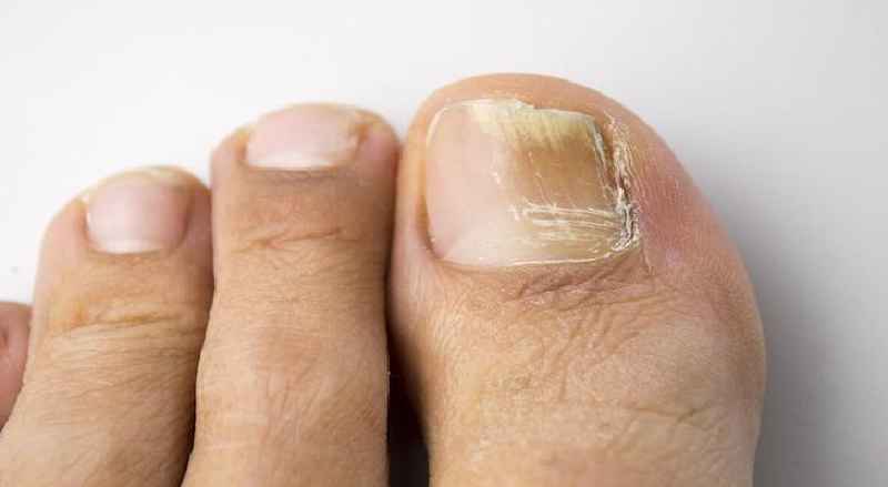 How do you get rid of a throbbing toenail