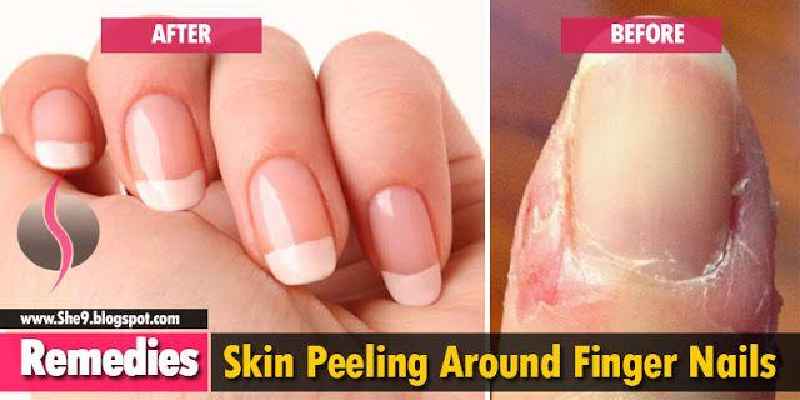 How do you get rid of an ingrown finger nail