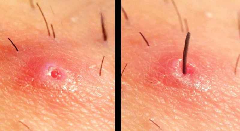 How do you get rid of an ingrown hair cyst at home