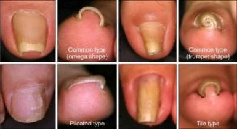 How do you get rid of buildup under your toenails