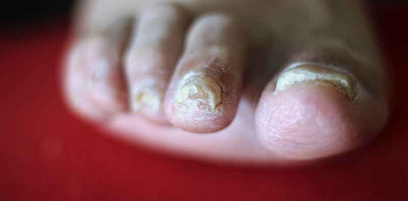 How do you get rid of fungal toenails