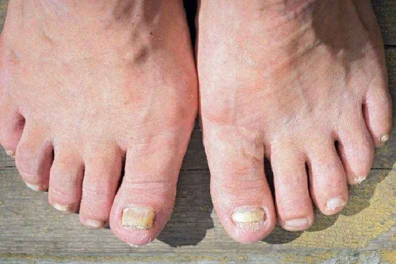 How do you get rid of hard cuticles on your toenails