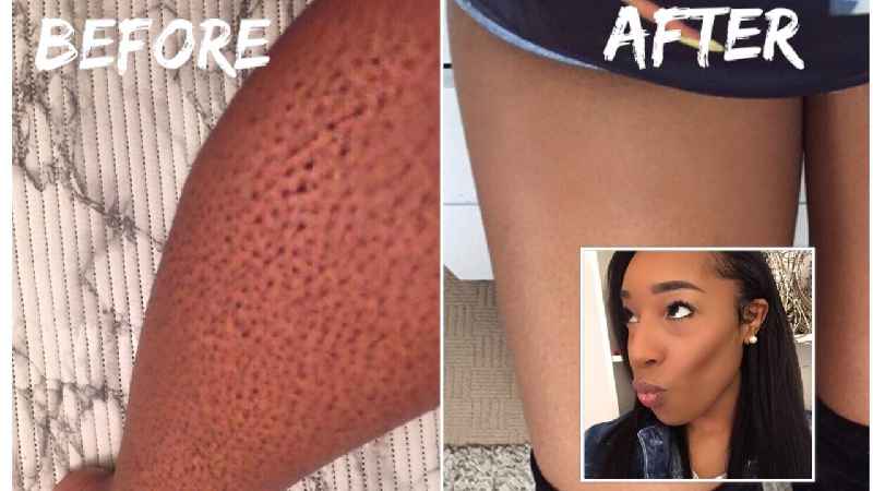 How do you get rid of ingrown hairs after removal