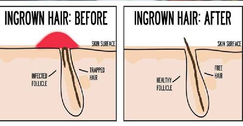 How do you get rid of ingrown hairs on your chin