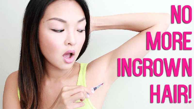 How do you get rid of ingrown hairs overnight