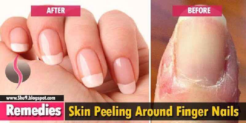 How do you get rid of nail marks