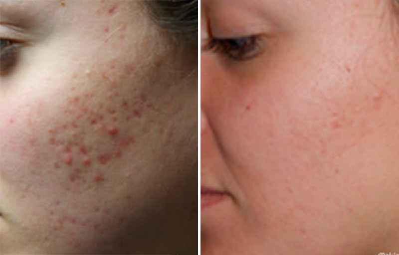 How do you get rid of pitted acne scars