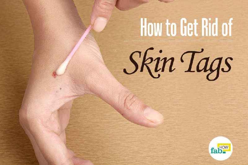 How do you get rid of skin tags with keratosis