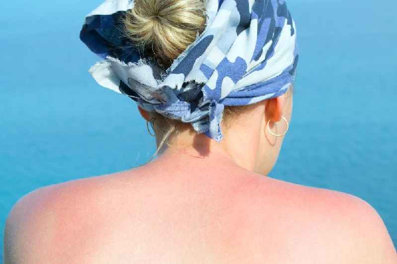 How do you get rid of sunburn redness overnight