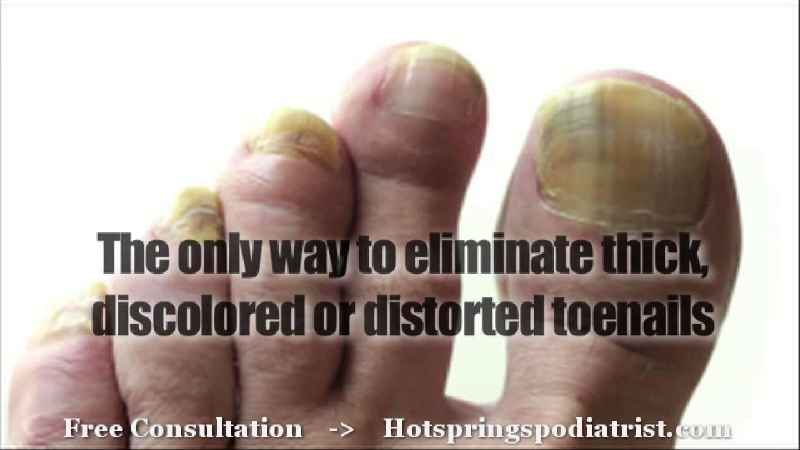 How do you get rid of thick toenails