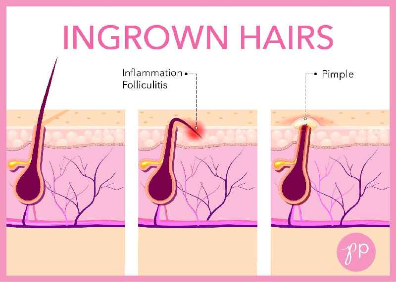 How do you heal an ingrown hair fast