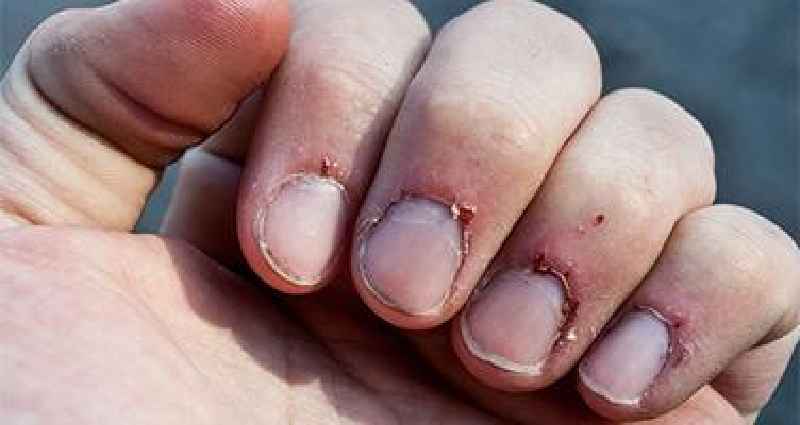 How do you heal scratched nails