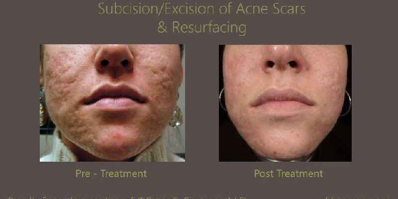 How do you hide deep acne scars
