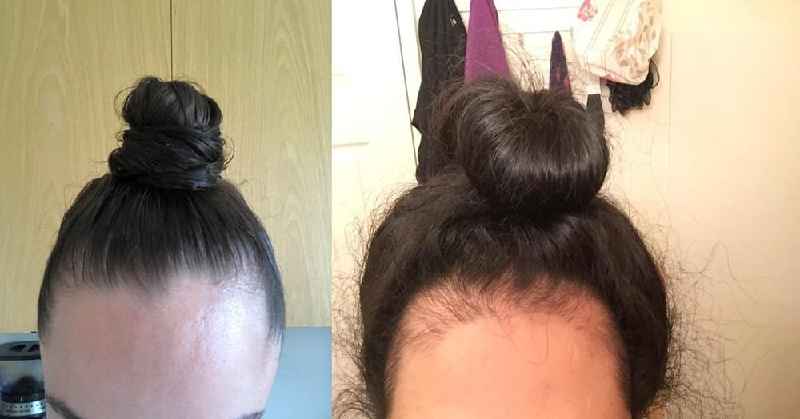 How do you know what is causing hair loss