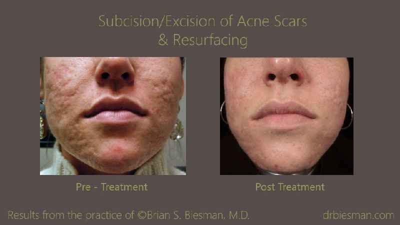 How do you lighten acne scars