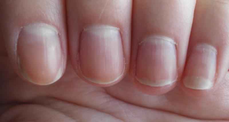 How do you restore a healthy nail bed