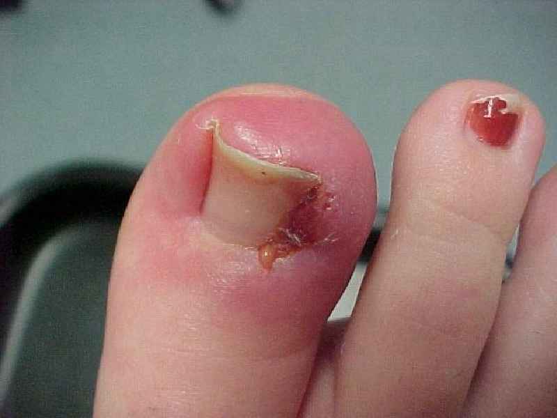 How do you soak an infected ingrown toenail