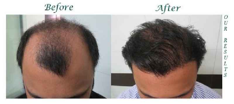 How do you stop hormonal hair loss naturally
