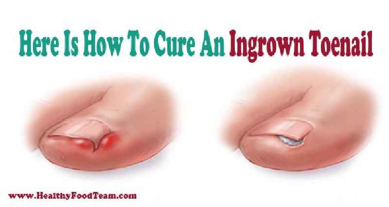 How do you stop ingrown toenail pain at night