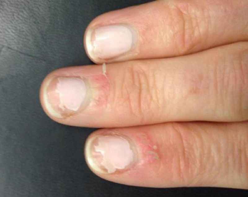 How do you stop nail fungus from spreading