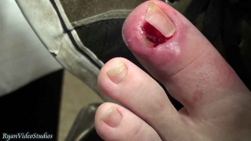 How do you tape an ingrown toenail