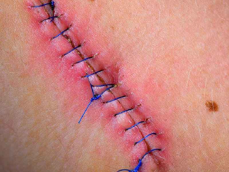 How do you tell if stitches are infected