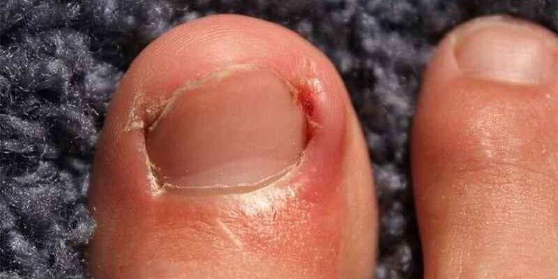 How do you treat a big toe nail injury