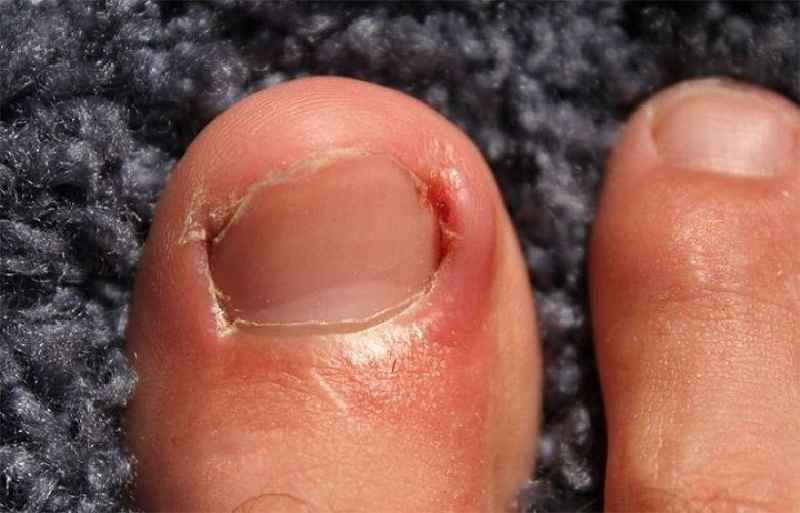 How do you treat a nail wound