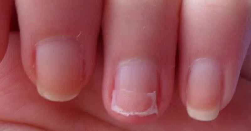 How do you treat a split nail