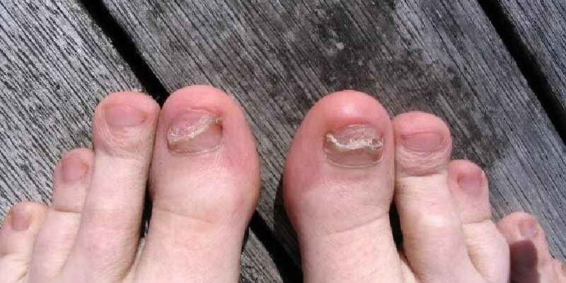 How do you treat a toe after the nail falls off
