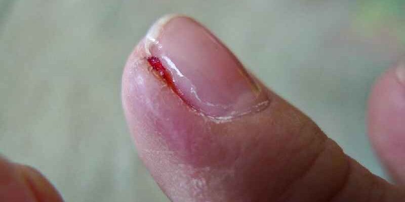 How do you treat an infected corner of nail