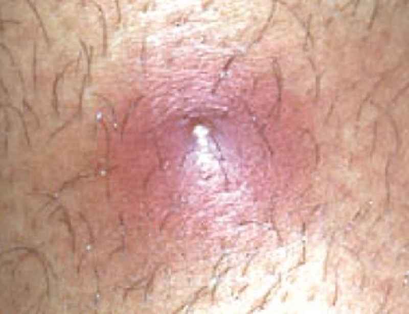 How do you treat an infected ingrown hair