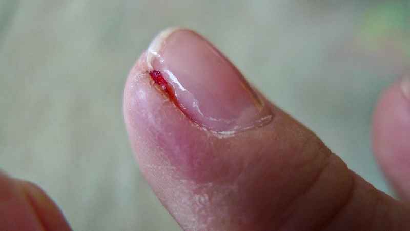 How do you treat an infected nail bed