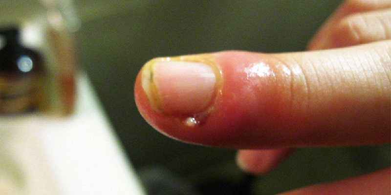 How do you treat nail trauma