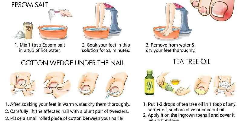 How do you treat toe after removing nail